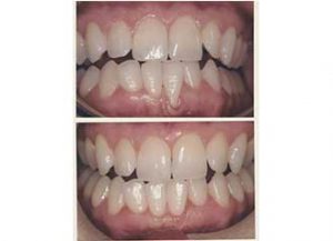 Periodontal surgery in Kolkata