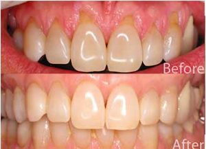 Periodontal scaling and root planing Kolkata