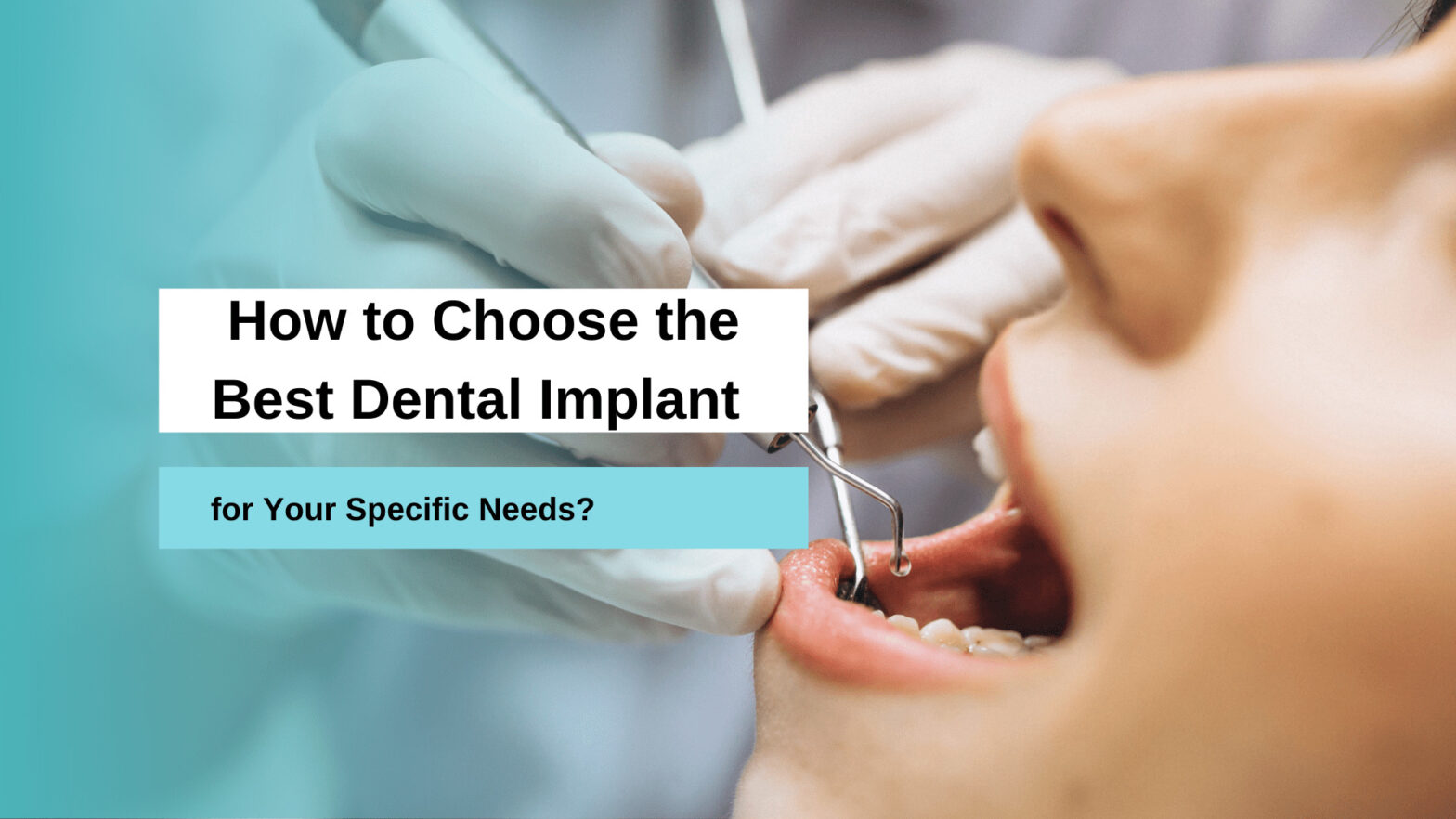 Best Dental Implant