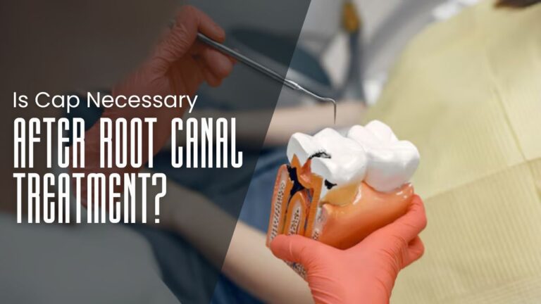 Is Cap Necessary After Root Canal Treatment? A Comprehensive Guide