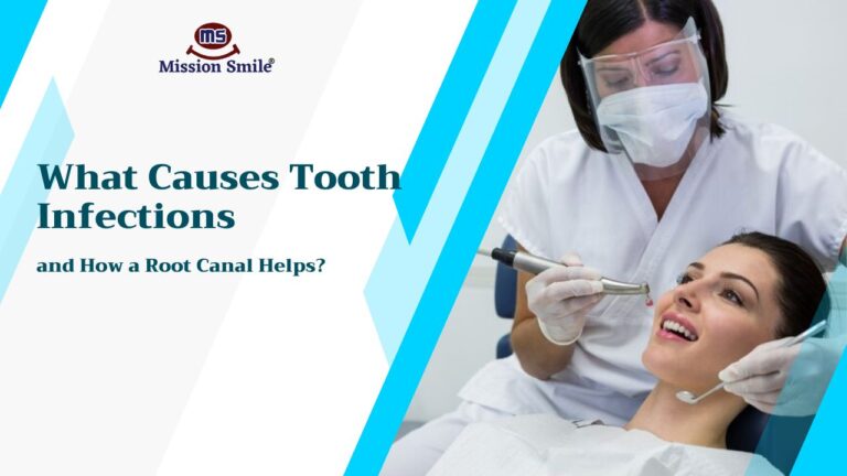 What Causes Tooth Infections and How a Root Canal Helps?
