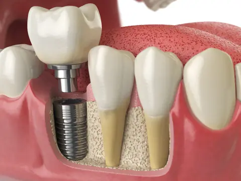Best Dental Implants Clinic In Kolkata
