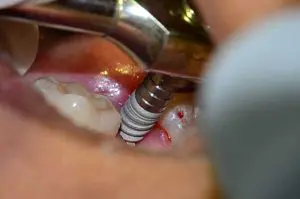 Popular Dental Implantology Training in Kolkata