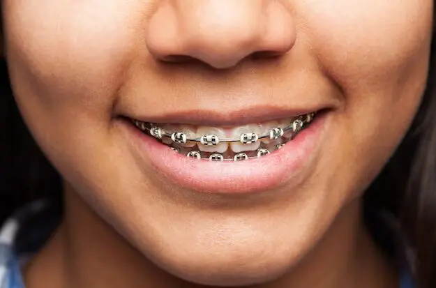 Fixed Braces in Kolkata
