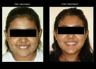 best invisible braces service doctors In ballygunge kolkata