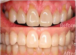 Periodontal scaling and root planing Kolkata