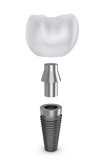 Dental Implants Kolkata