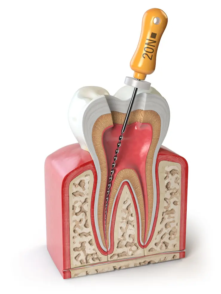 Root Canal Treatment in Kolkata
