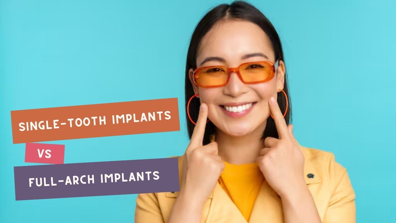 Single-Tooth Implants vs Full-Arch Implants