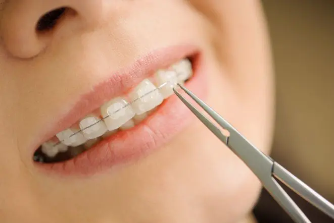 invisible teeth braces in Kolkata